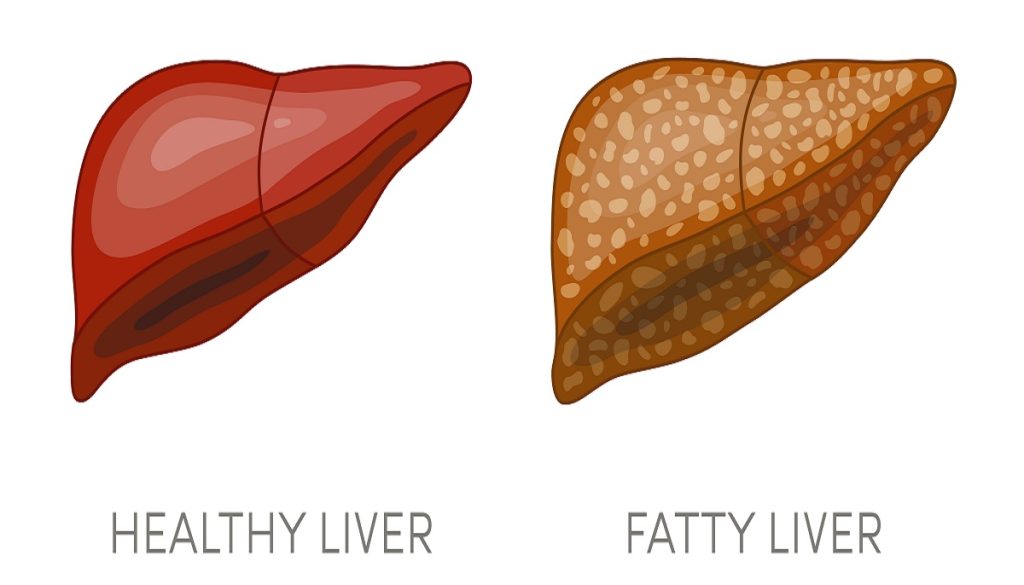 Fatty,Liver,Disease.,Vector,Illustration,Of,A,Healthy,And,A