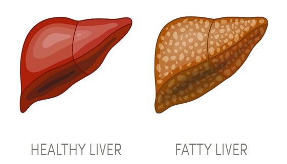 Fatty,Liver,Disease.,Vector,Illustration,Of,A,Healthy,And,A